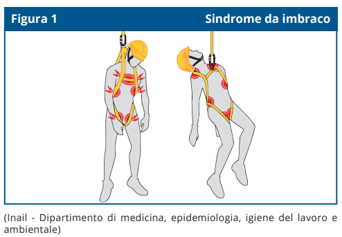 Sindrome da imbraco